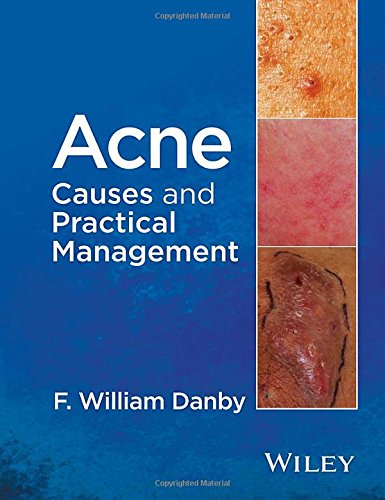 Acne Causes And Practical Management 1st Edition F William Danby