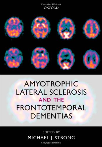 Amyotrophic Lateral Sclerosis And The Frontotemporal Dementias 1st Edition Michael J Strong