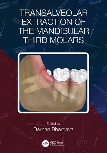 Transalveolar Extraction Of The Mandibular Third Molars Darpan Bhargava