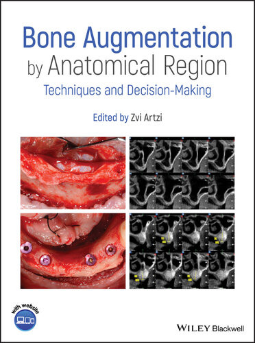 Bone Augmentation By Anatomical Region Techniques And Decisionmaking Zvi Artzi