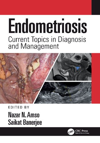 Endometriosis Current Topics In Diagnosis And Management Nazar Amso