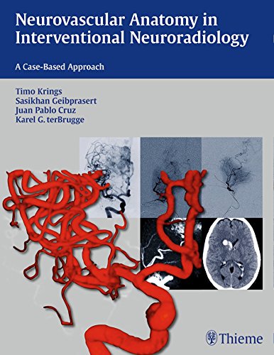 Neurovascular Anatomy In Interventional Neuroradiology A Casebased Approach 1st Edition Timo Krings