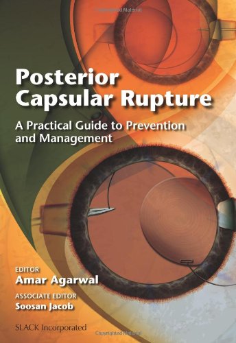 Posterior Capsular Rupture A Practical Guide To Prevention And Management 1st Edition Amar Agarwal Ed