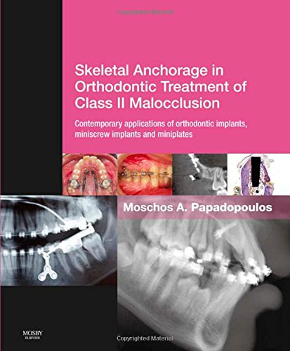 Skeletal Anchorage In Orthodontic Treatment Of Class Ii Malocclusion Contemporary Applications Of Orthodontic Implants Miniscrew Implantsand Mini Plates 1e 1st Edition Moschos A Papadopoulos