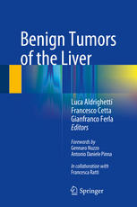 Benign Tumors Of The Liver 1st Edition Luca Aldrighetti Francesco Cetta