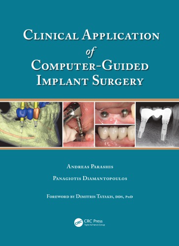 Clinical Application Of Computerguided Implant Surgery Diamantopoulos