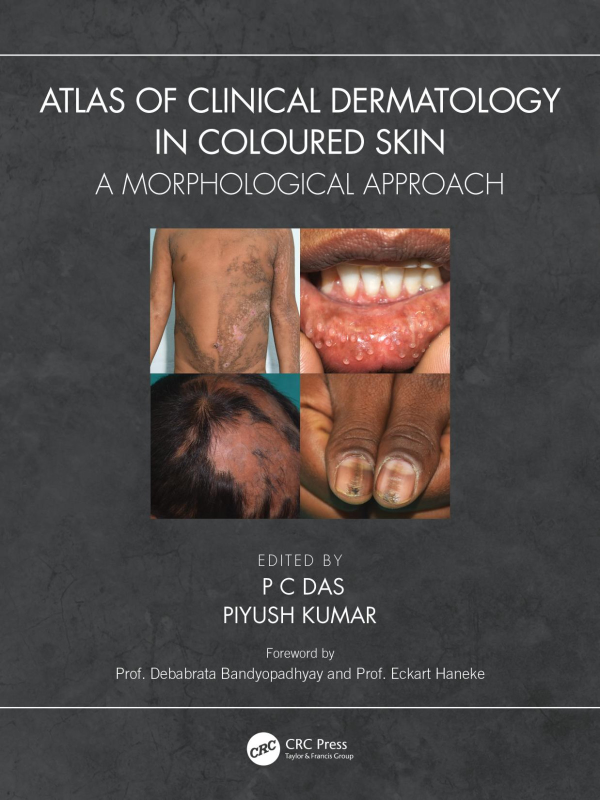Atlas Of Clinical Dermatology In Coloured Skin A Morphological Approach 1st P C Das