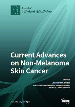 Current Advances On Nonmelanoma Skin Cancer Constantin Caruntu