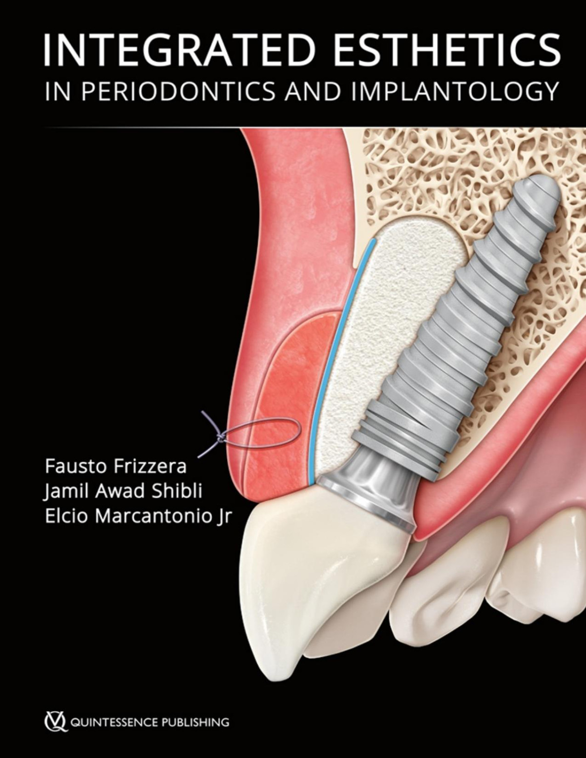 Integrated Esthetics In Periodontics And Implantology Fausto Frizzera Jamil Awad Shibli Elcio Marcantonio Jr Quintessence 2022tls Fausto Frizzerajamil Awad Shiblielcio Marcantonio Jamil Awad Shibli Elcio Marcantonio