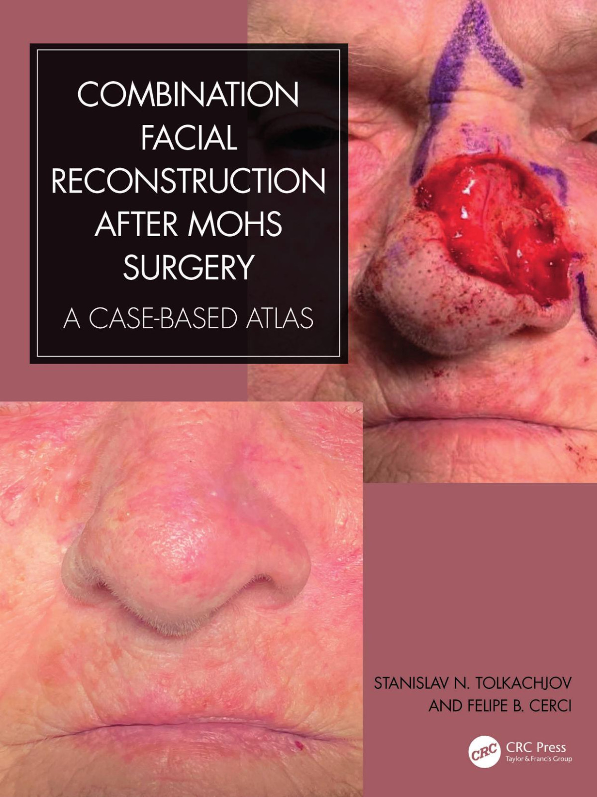 Combination Facial Reconstruction After Mohs Surgery A Case Based Atlas Stanislav N Tolkachjov Felipe B Cerci