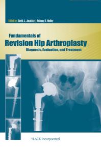 Fundamentals Of Revision Hip Arthroplasty Diagnosis Evaluation And Treatment 1st Edition David Jacofsky Anthony Hedley