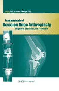 Fundamentals Of Revision Knee Arthroplasty Diagnosis Evaluation And Treatment 1st Edition David Jacofsky Anthony Hedley