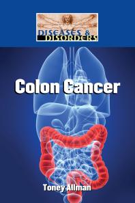Colon Cancer 1st Edition Toney Allman