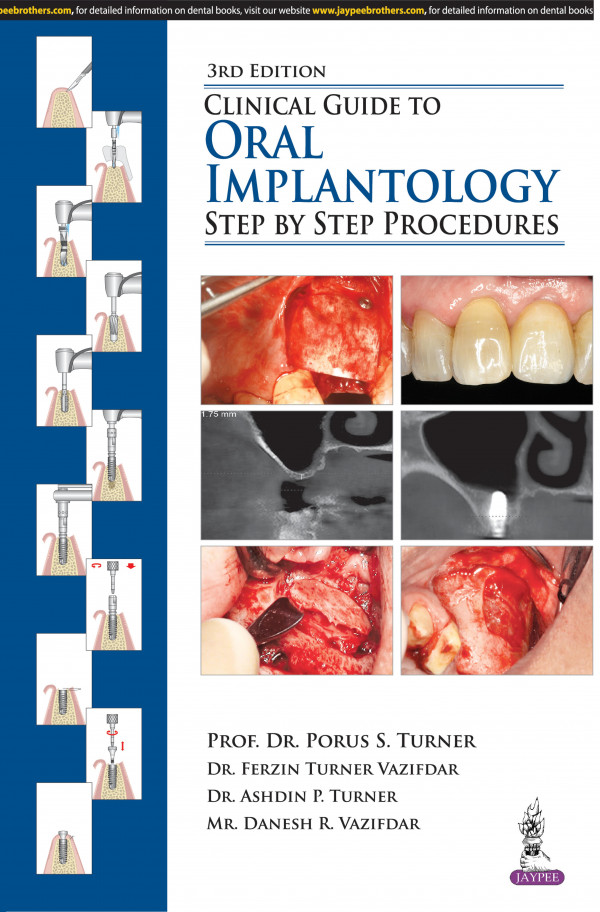 Clinical Guide To Oral Implantology Step By Step Procedures 3rd Edition Porus S Turner Ferzin Turner Vazifdar Ashdin P Turner
