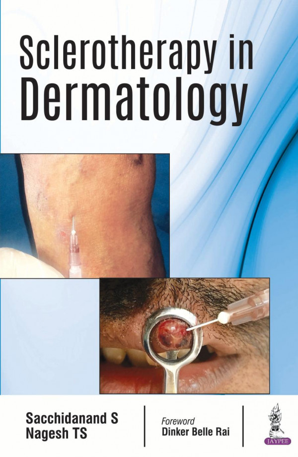 Sclerotherapy In Dermatology 1st Edition Sacchidanand S Nagesh Ts