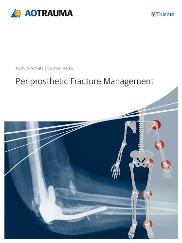 Periprosthetic Fracture Management 1st Edition Michael Schuetz