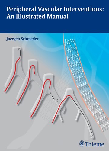 Peripheral Vascular Interventions An Illustrated Manual 1st Edition Juergen Schroeder