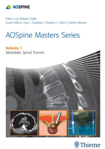 Aospine Masters Series Volume 1 Metastatic Spinal Tumors 1st Edition Luiz Roberto Gomes Vialle