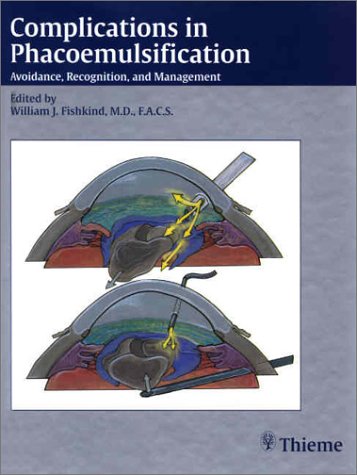 Complications In Phacoemulsification Avoidance Recognition And Management 1st Edition William J Fishkind