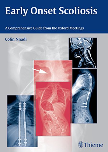 Early Onset Scoliosis A Comprehensive Guide From The Oxford Meetings 1st Edition Nnadi