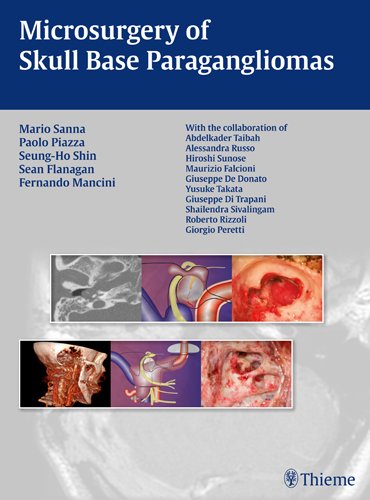 Microsurgery Of Skull Base Paragangliomas 1st Edition Mario Sanna