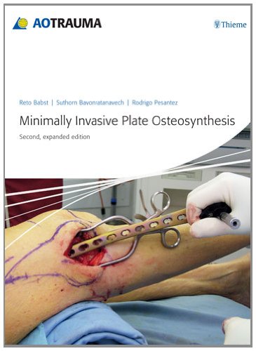 Minimally Invasive Plate Osteosynthesis 2nd Edition Reto Babst