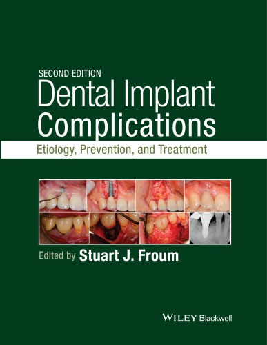 Dental Implant Complications Stuart Froum
