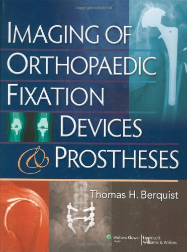 Imaging Of Orthopaedic Fixation Devices And Prostheses 1st Edition Thomas H Berquist