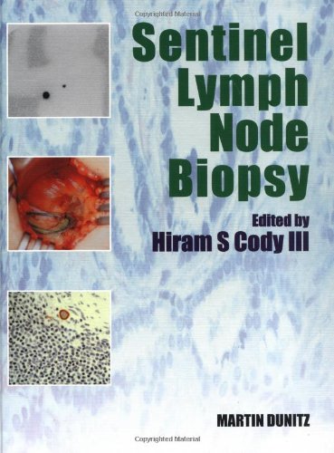 Sentinel Lymph Node Biopsy 1st Edition Cody Hiram S