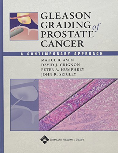Gleason Grading Of Prostate Cancer A Contemporary Approach First Edition Mahul B Amin