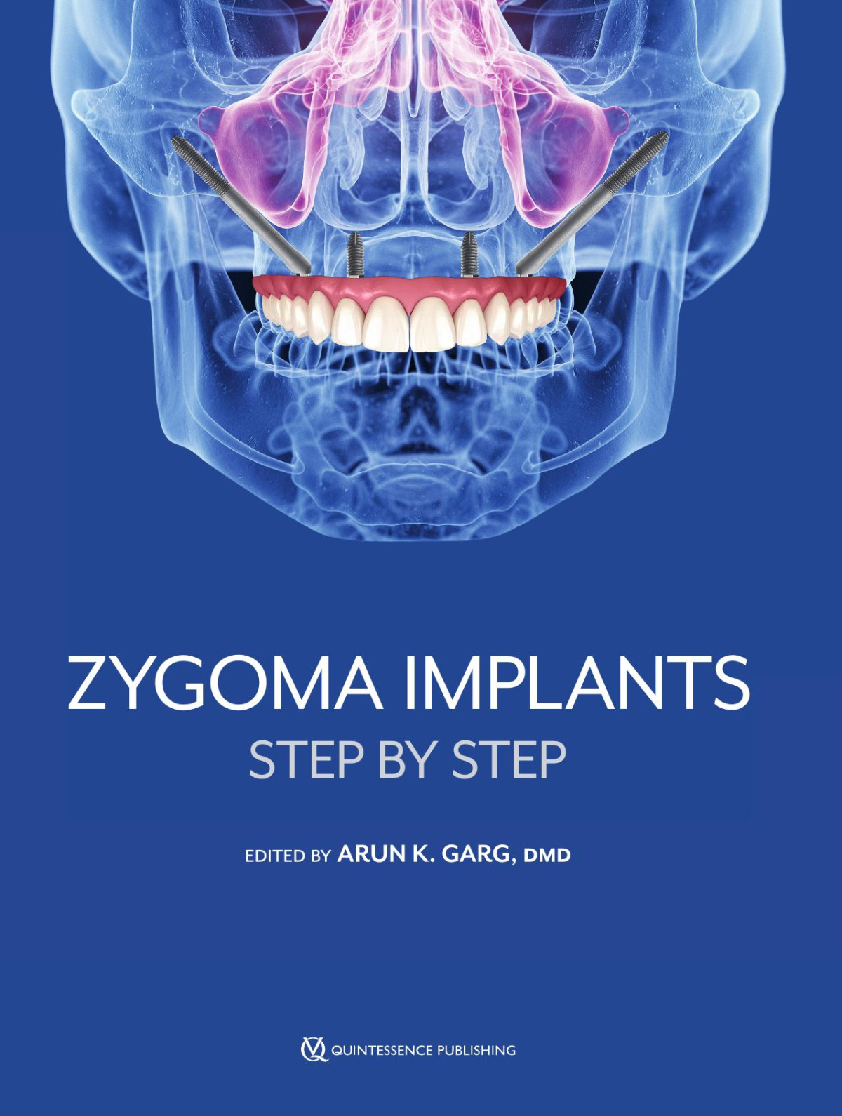 Zygoma Implants Step By Step Arun K Garg