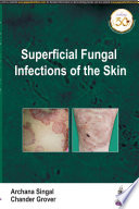 Superficial Fungal Infections Of The Skin Archana Singal Chander Grover