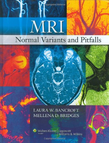 Mri Normal Variants And Pitfalls 1st Edition Laura W Bancroft Md