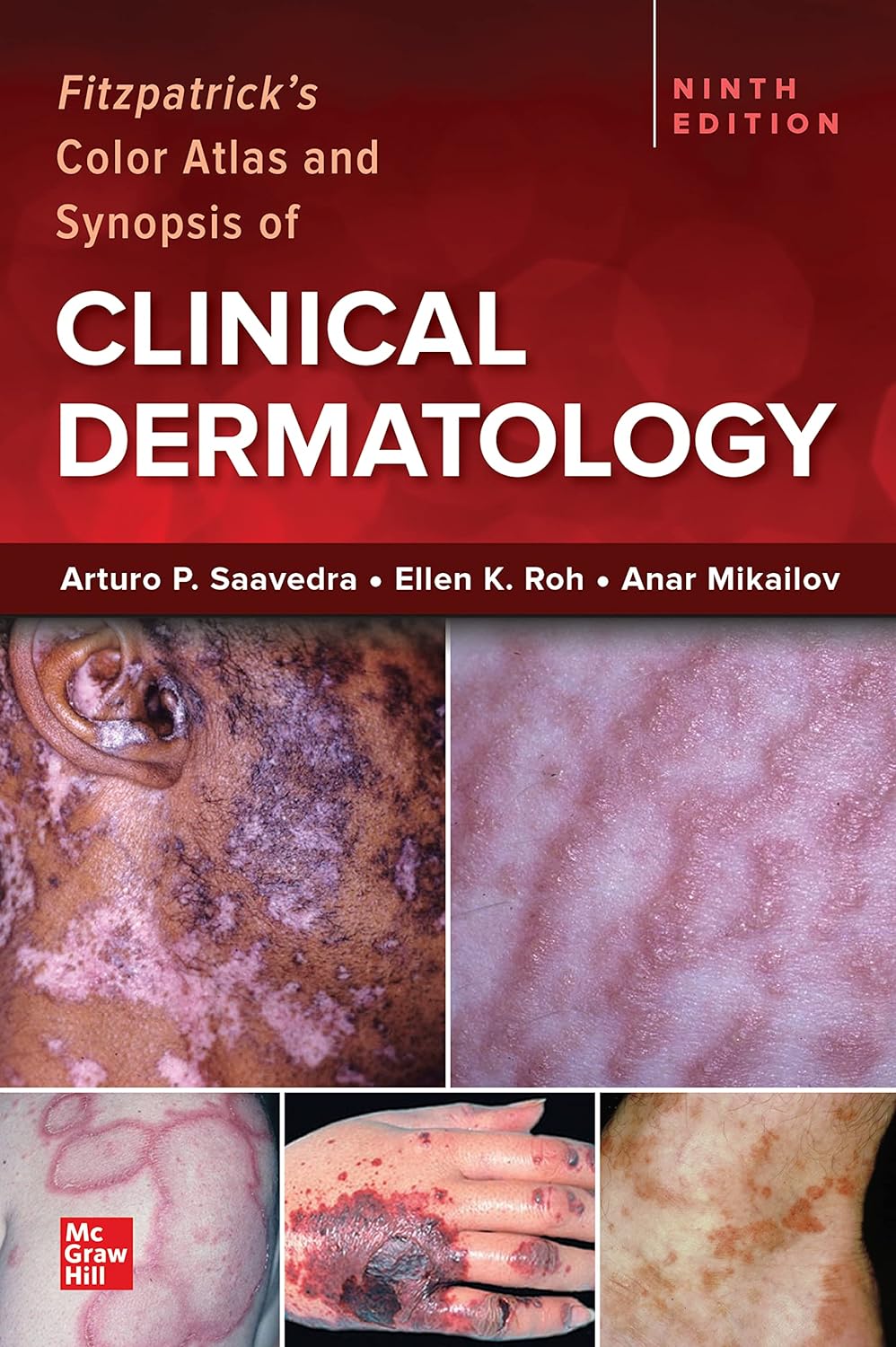 Fitzpatricks Color Atlas And Synopsis Of Clinical Dermatology Ninth Edition 9th Edition Saavedra