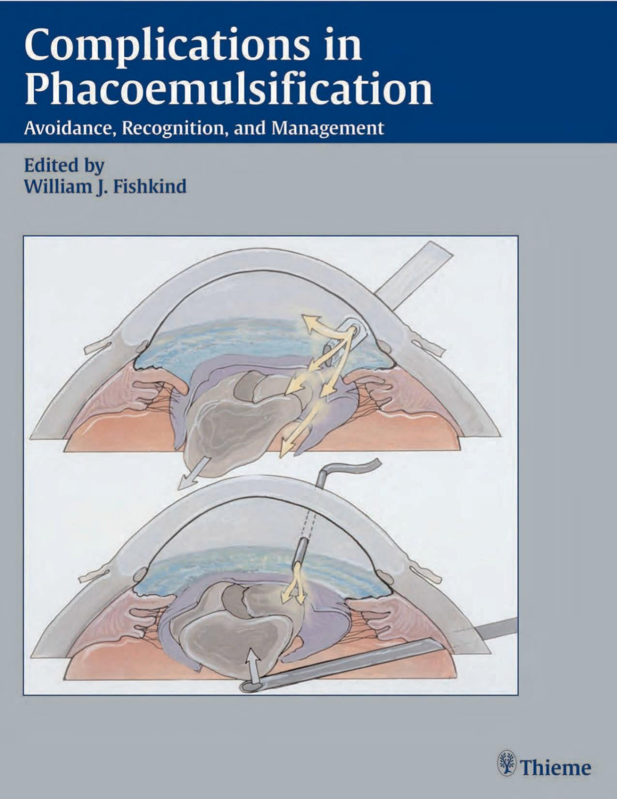 Complications In Phacoemulsification Wiliam J Fishkind