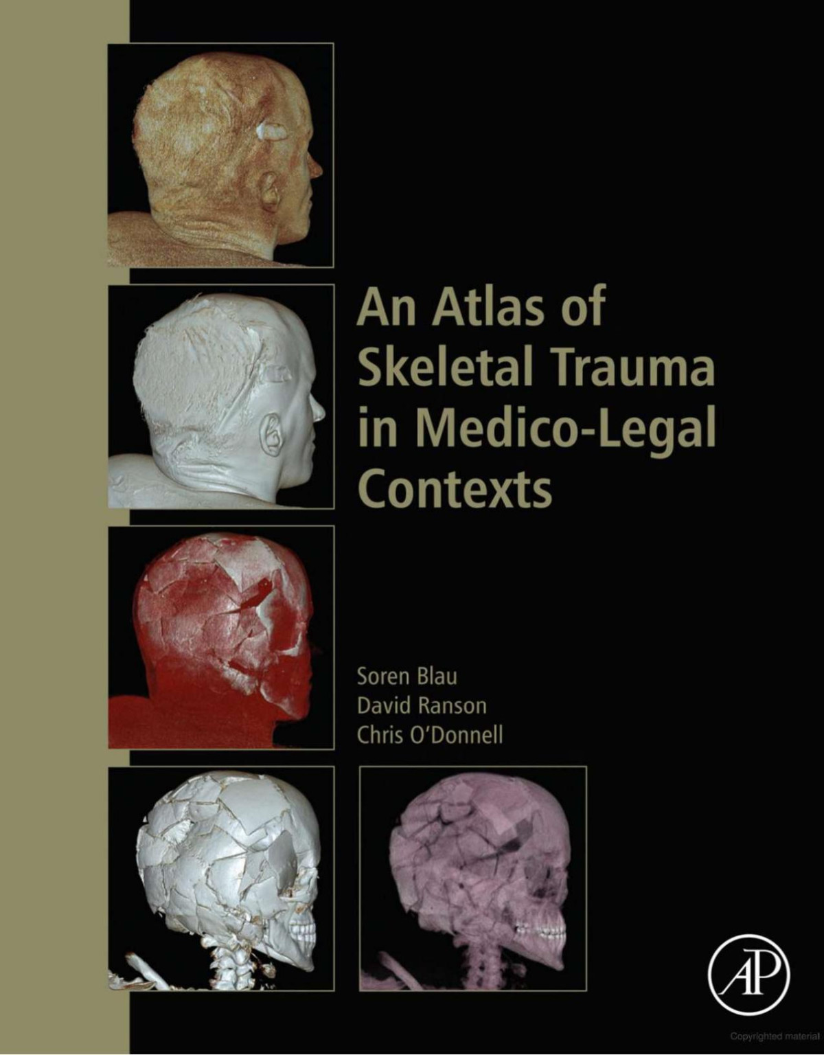 An Atlas Of Skeletal Trauma In Medicolegal Contexts 1st Edition Blau