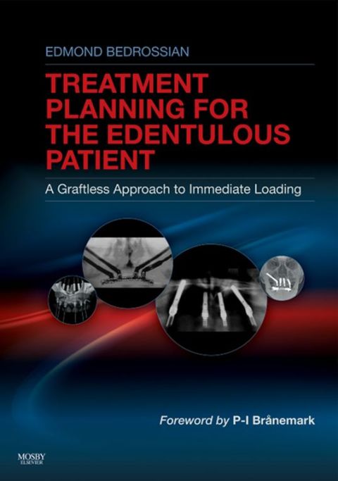 Implant Treatment Planning For The Edentulous Patient A Graftless Approach To Immediate Loading 1st Edition Bedrossian Dds Facd Facoms