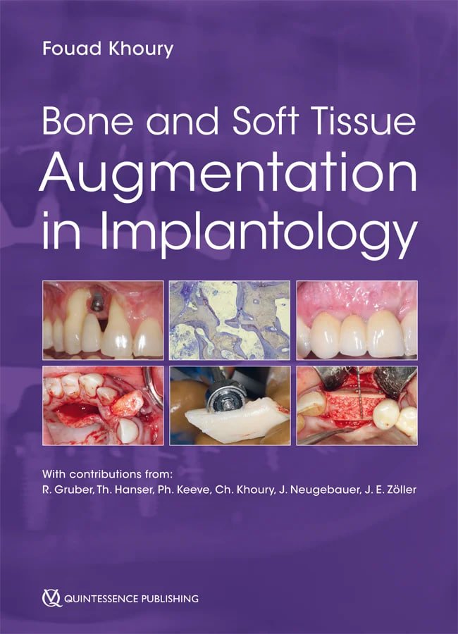 Bone And Soft Tissue Augmentation In Implantology 1st Edition Fouad Khoury