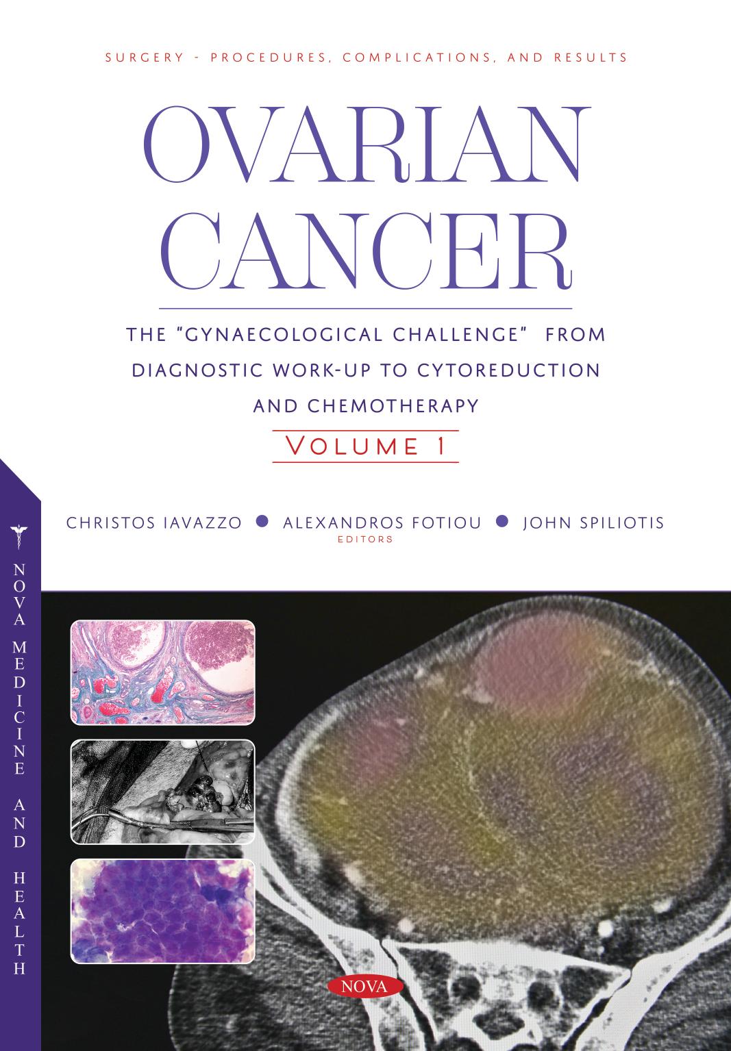 Ovarian Cancer The Gynaecological Challenge From Diagnostic Workup To Cytoreduction And Chemotherapy Volume 1 1st Edition Iavazzo