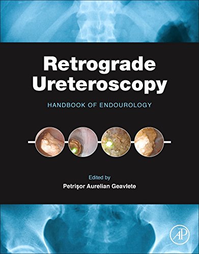 Retrograde Ureteroscopy Handbook Of Endourology 1st Edition Petrisor Aurelian Geavlete