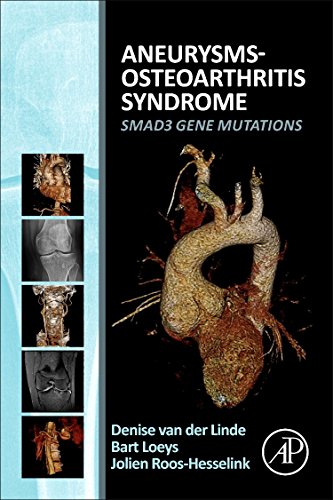 Aneurysmsosteoarthritis Syndrome Smad3 Gene Mutations 1st Edition Denise Van Der Linde