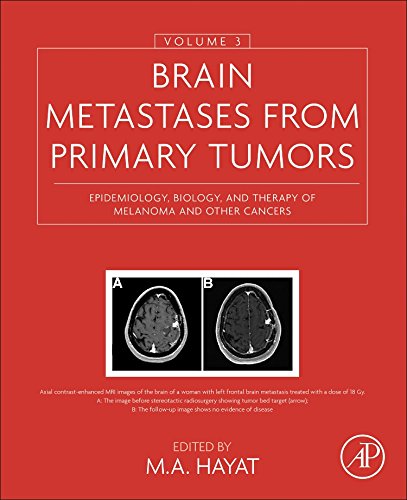 Brain Metastases From Primary Tumors Volume 3 Epidemiology Biology And Therapy Of Melanoma And Other Cancers 1st Edition M A Hayat