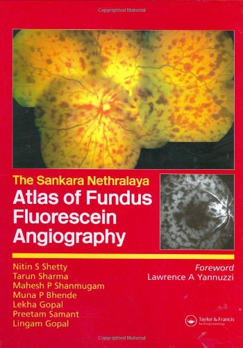 Atlas Of Fundus Fluorescein Angiography 1st Edition Nitin Shetty