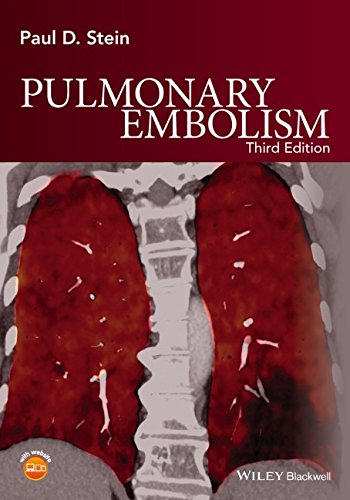 Pulmonary Embolism 3rd Edition Paul D Stein