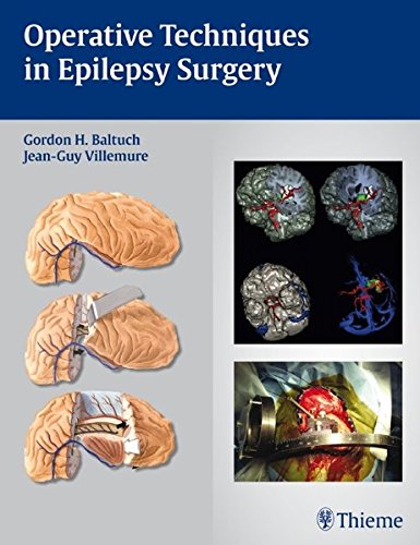 Operative Techniques In Epilepsy Surgery 1st Edition Baltuch