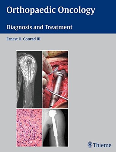 Orthopaedic Oncology Diagnosis And Treatment 1st Edition Ernest U Conrad Iii