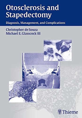 Otosclerosis And Stapedectomy Diagnosis Management And Complications Christopher De Souza