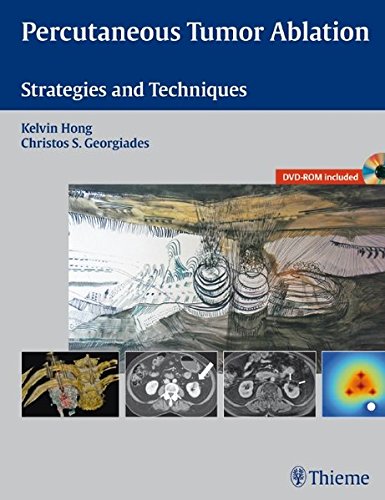 Percutaneous Tumor Ablation Strategies And Techniques 1 Hardvdr Hiscock