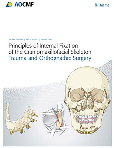 Principles Of Internal Fixation Of The Craniomaxillofacial Skeleton Trauma And Othognathic Surgery 1st Edition Joachim Prein