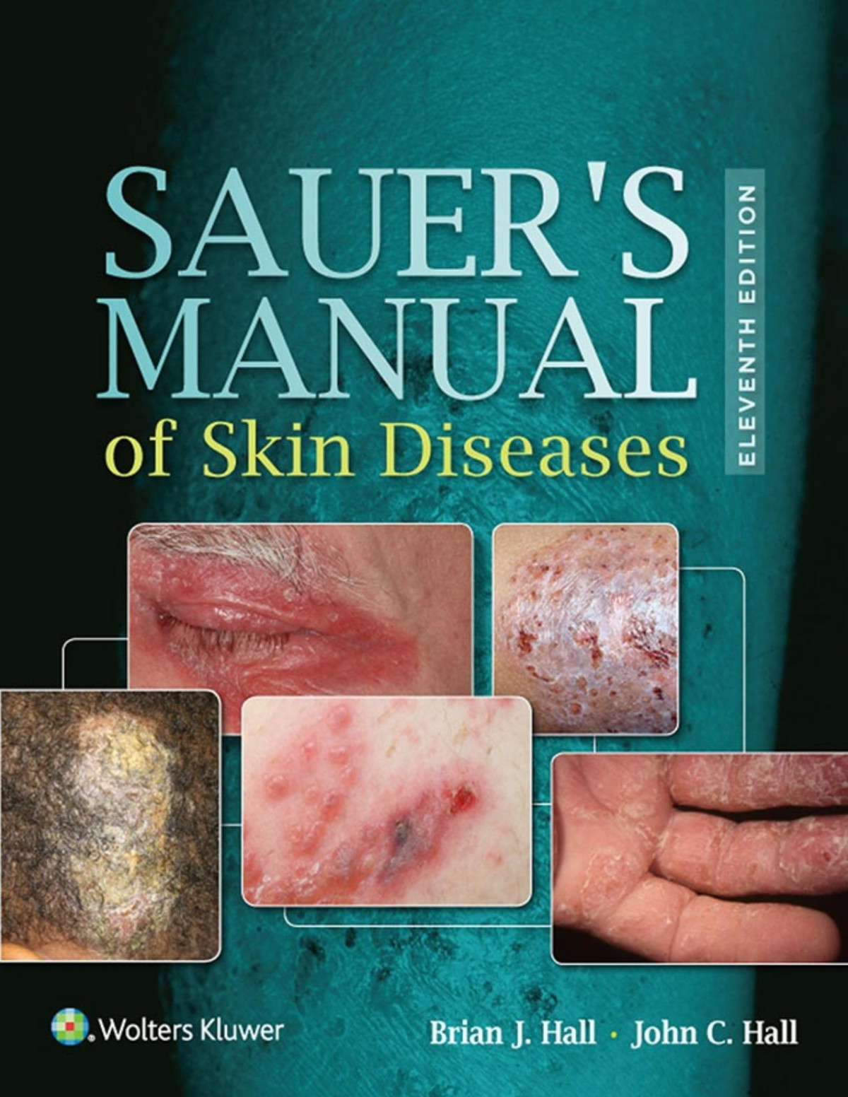 Sauers Manual Of Skin Diseases 11th Edition 11th Brian J Hall